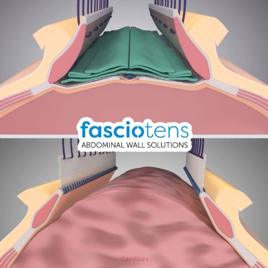 Fasciotens | Abdominal Wall Solutions | Tutku Sağlık