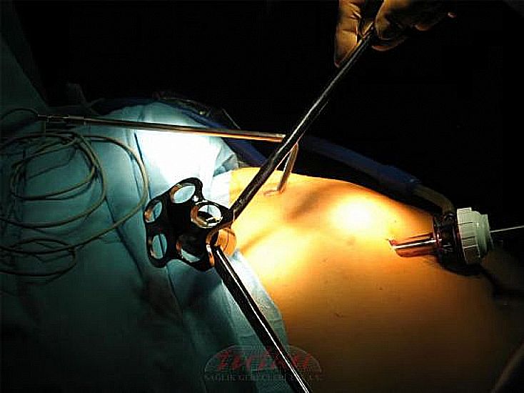 Nathanson Liver Retractor Systems | Tutku Sağlık