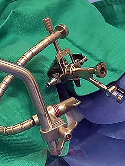 CystoAssist attaches directly to the cystoscope sheath, allowing UO access, drainage, irrigation, or changing to the obturator for maximum flexibility. 