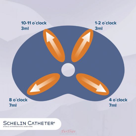 Schelin Catheter | Tutku Sağlık
